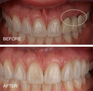 Dark lines around crowns corrected with all porcelain or ceramic crowns