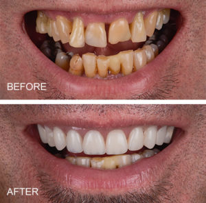 Same day teeth. Implants replacing teeth treated in one day