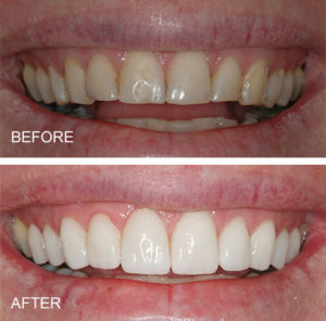 Old stained bonding replaced with porcelain veneers/laminates. Smile makeover