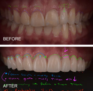 Digital smile design can demonstrate smile makeovers before beginning any treatment