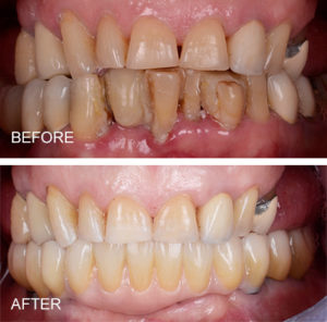 Periodontal disease leaving teeth loose and hopeless replaced with implants and zirconia hybrid restoration
