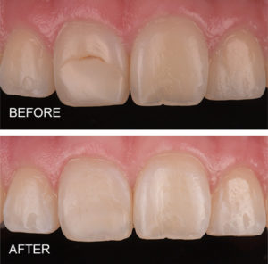Stained bonding replaced with bonding blending seamlessly with enamel