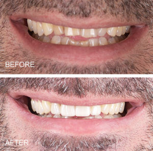 Worn teeth reconstructed with porcelain crowns. Smile makeover