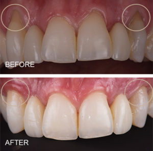 Gingival (gum) recession treated with grafting achieving full root coverage