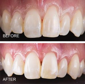 Cosmetic gum grafting for root coverage on front tooth