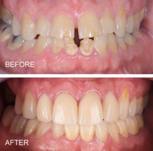 Porcelain crowns to correct diastema (spacing) and chipped front teeth