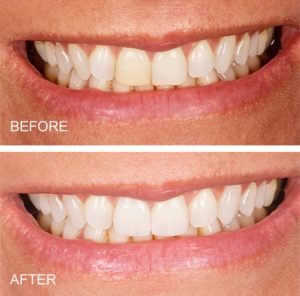 Old, stained bonding and chipped front tooth was restored with a porcelain crown and veneer