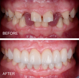 Porcelain bridges replacing congenitally missing teeth
