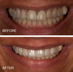 Crowns with dark margins, old bonding, and a fractured tooth are replaced with a dental implant and porcelain emax crowns