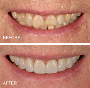 Worn front teeth restored with all ceramic crowns