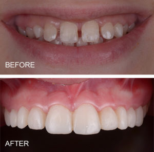 Spaces between front teeth can be closed with bonding