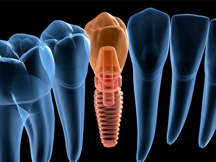 All On 4 Dental Implants Paoli PA
