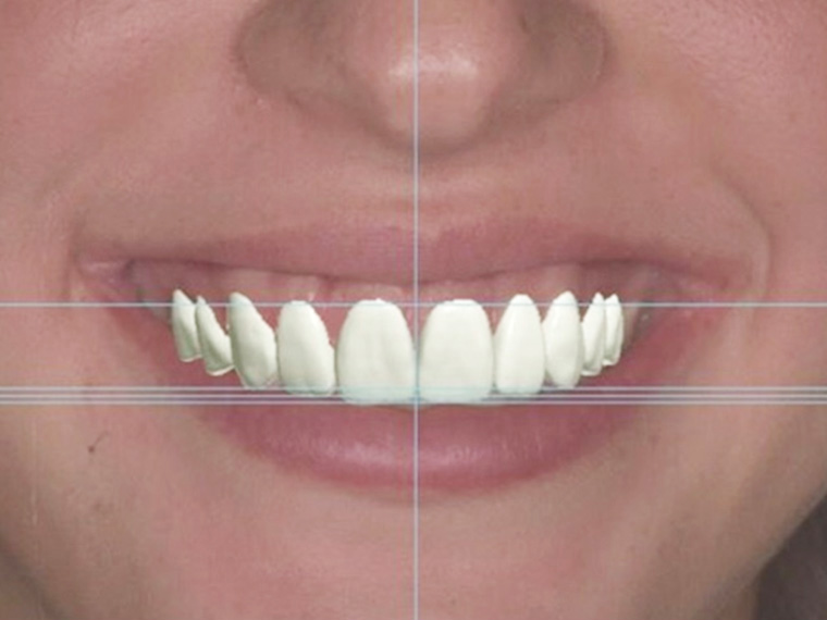 All On 4 Dental Solutions Paoli PA
