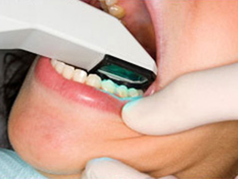 Full Mouth Dental Implants Philadelphia
