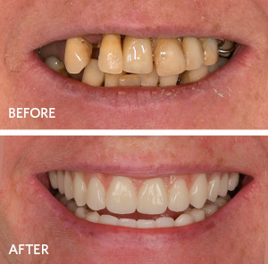 before and after same day new teeth treatment