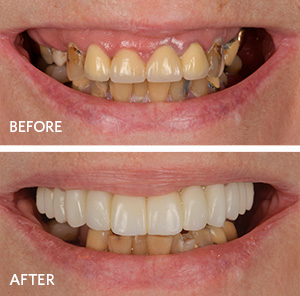 before and after same day new teeth treatment