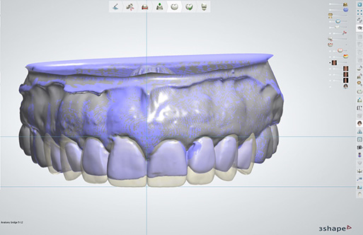 digital smile design model