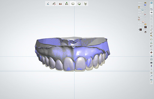 digital smile design model