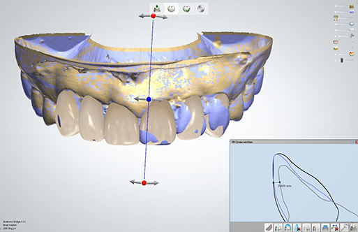 digital smile design model