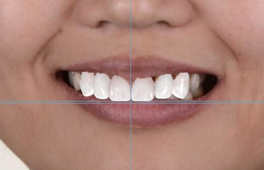 digital smile design simulation