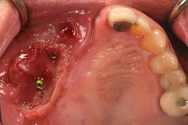 oral cancer reconstruction