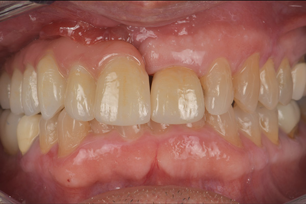 oral cancer reconstruction