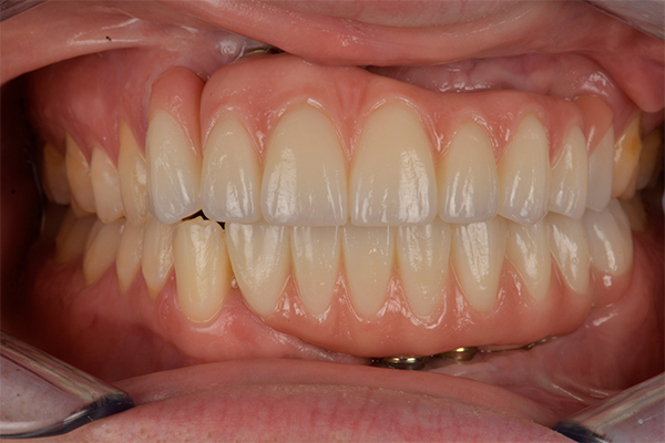 Facial dental trauma